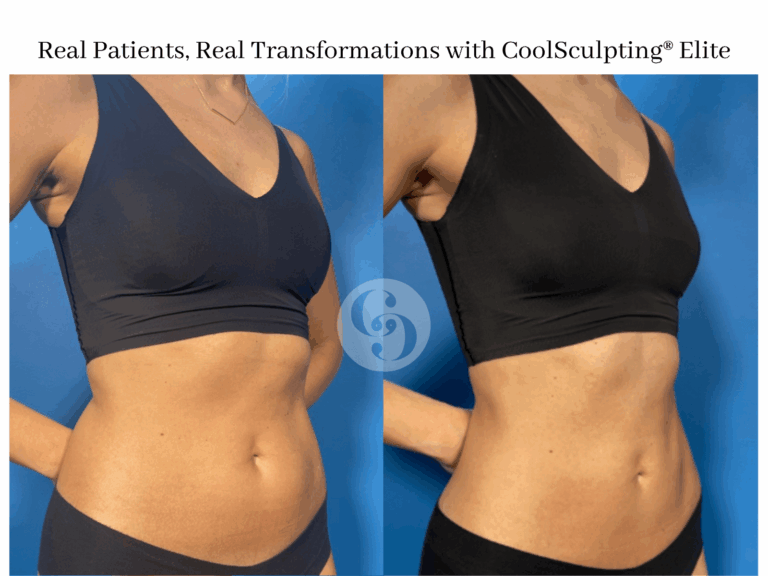 CoolSculpting GIF 18 1 768x576